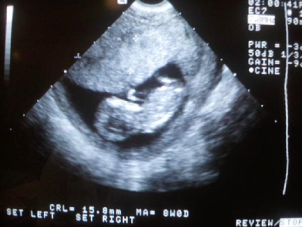 11 неделя беременности фото