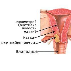 рак матки фото